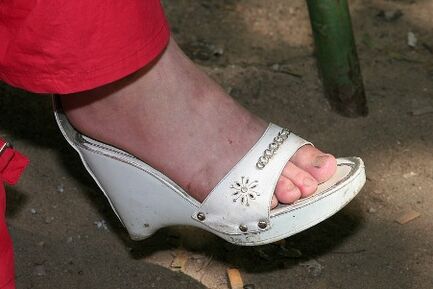 Pomanjkanje ustrezne higiene stopal je razlog za razvoj glivic