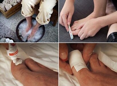 Parjenje stopal in nanašanje kreme s sečnino na nohte, prizadete od glivic
