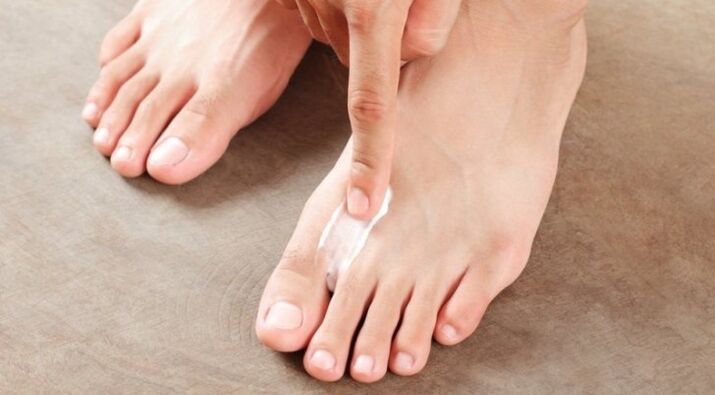 kako in kako zdraviti glivico med prsti na nogah