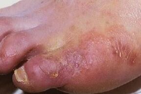 manifestacije glivične okužbe na koži nog