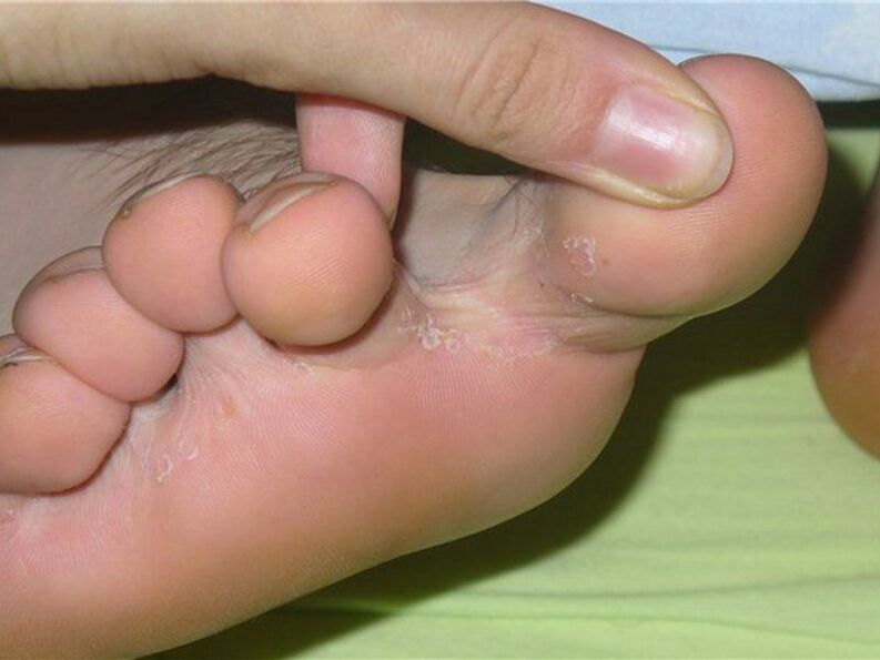 Glivice med prsti na nogi fotografija 1