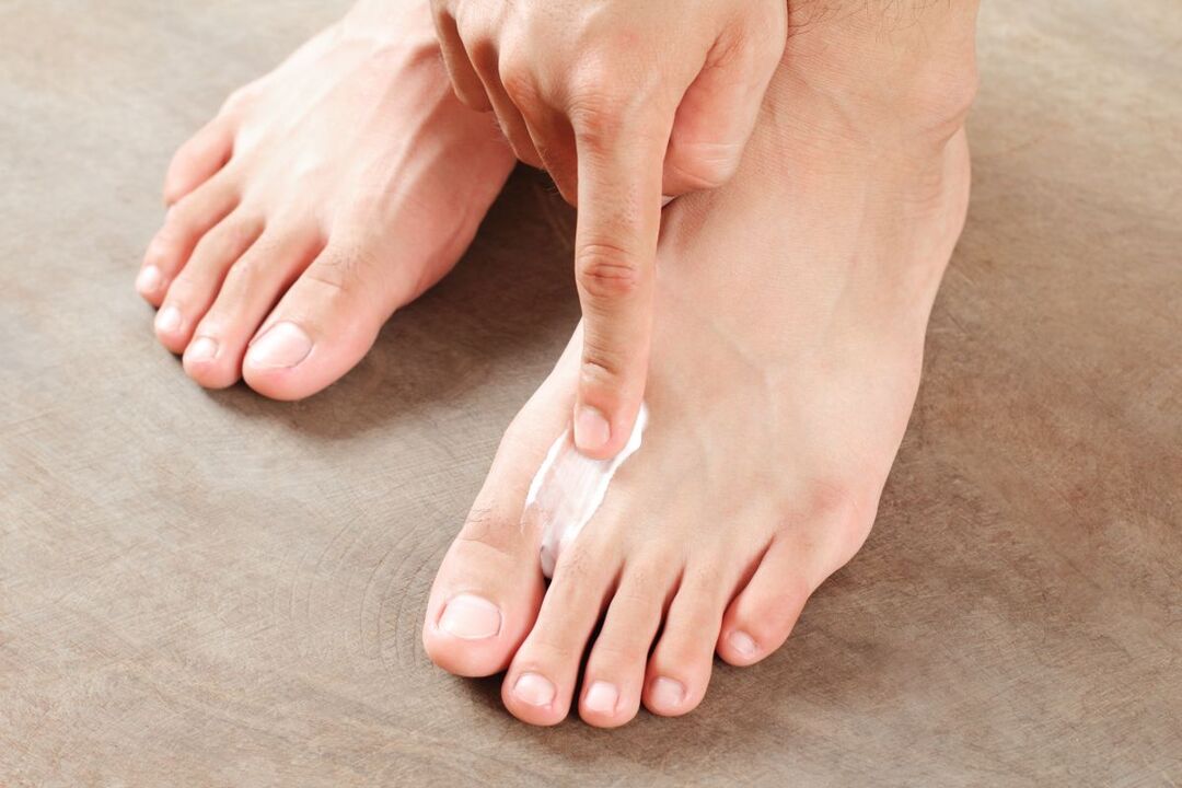 zdravljenje glivic na nogah z mazilom