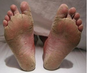 stopala glive izgleda