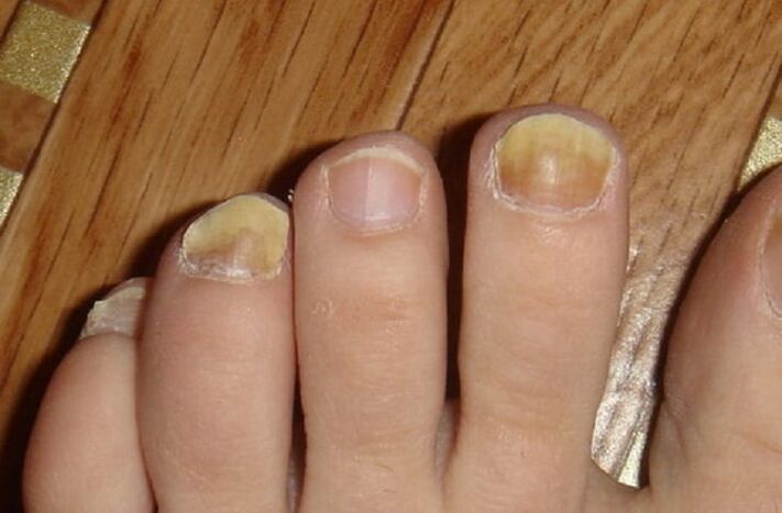 simptomi glivic na nohtih in koži stopal